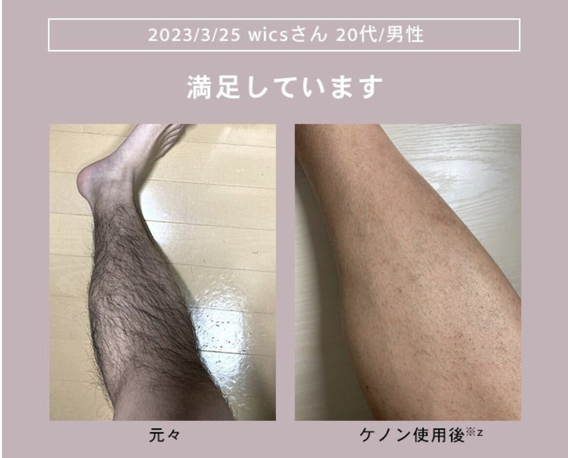 【ケノン】男性使用例（すね毛）