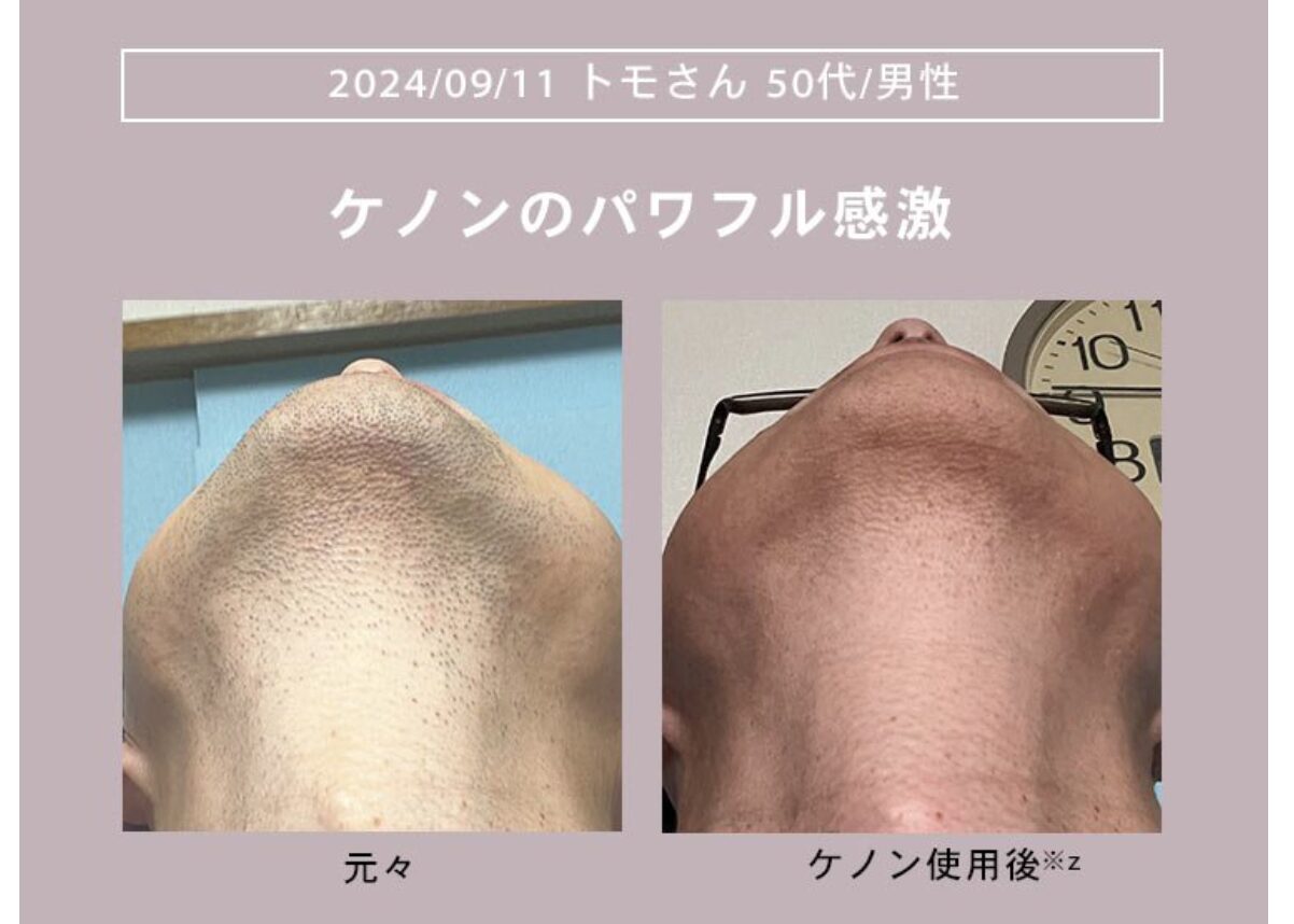 【ケノン】男性の使用例（ヒゲ）